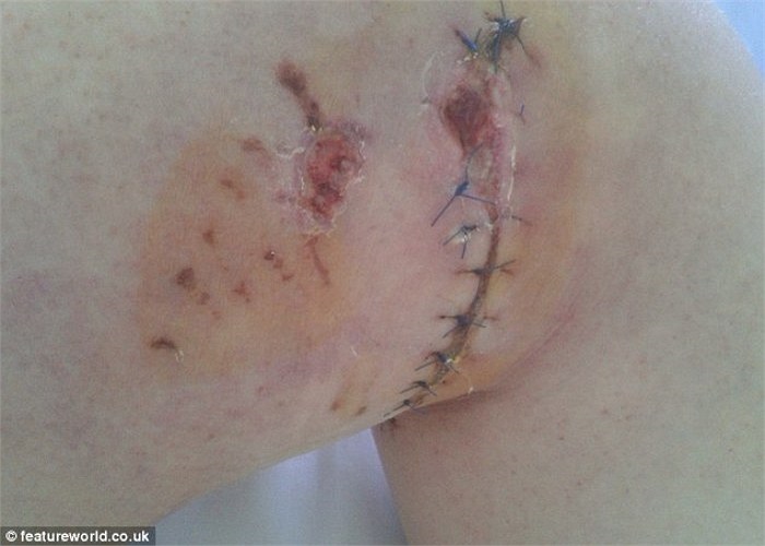 Rất may là sau đó, một nhân viên vườn thú cùng chị của nạn nhân đã nhanh chóng lao vào hỗ trợ giải cứu cho cô sinh viên này. Hậu quả đã khiến chị phải khâu hàng chục mũi trên đùi và để lại nỗi sợ hãi kinh hoàng. 