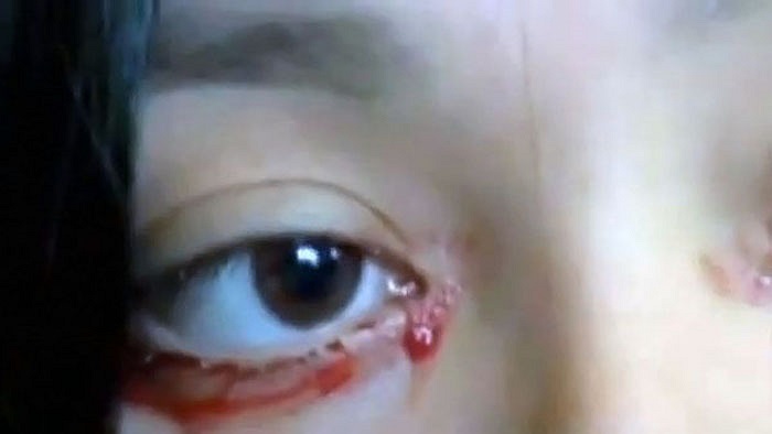 Oliva, 20 tuổi, một cô gái người Chile không may mắn đã mắc phải căn bệnh này. Từ khi mắc bệnh, gia đình cô trở nên điêu đứng. Số tiền mà gia đình cô tích cóp, dành dụm bấy lâu đã hết sạch vì việc chữa bệnh cho cô.