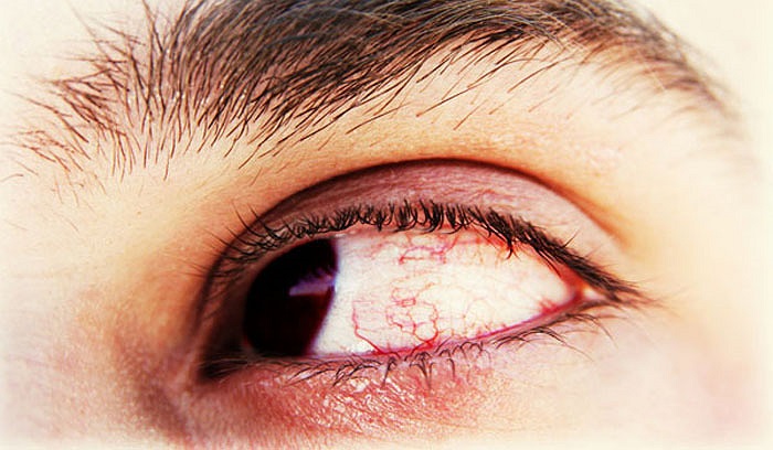 Đã không có ai dám đến gần em. Họ cho rằng bệnh này thật kinh tởm và nghĩ rằng em bị quỷ ám. Sau đó em bị nhà trường cho nghỉ học và em không được nhận vào bất kỳ trường nào khác.