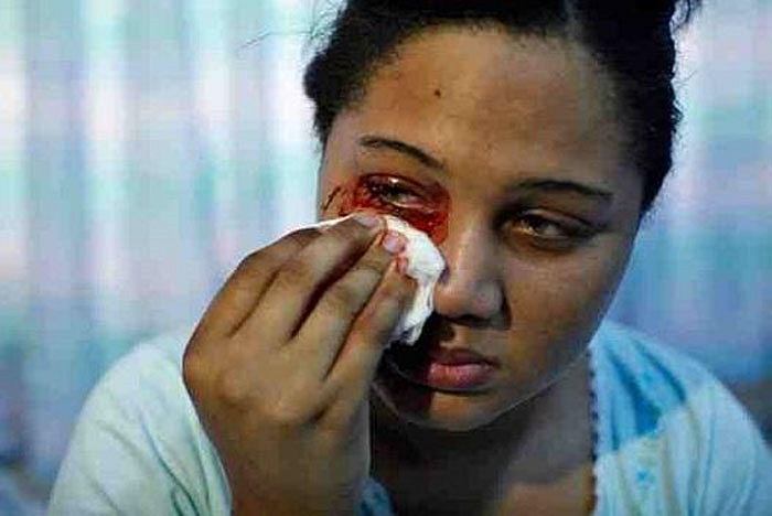 Khóc ra máu là nỗi sợ hãi, đau khổ, tuyệt vọng của những ai mắc phải nó. Tuy nhiên khóc ra máu lại là điều thú vị với một số ít người.