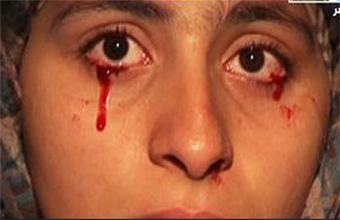 Tuy có hơi chút bối rối khi thấy máu túa ra từ đôi mắt của mình, nhưng cô không cảm thấy đau khổ, mặc cảm hay xem đó là điều bất hạnh. Ngược lại Rashida còn thấy đó là một điều kỳ diệu mà thánh thần, đức chúa ưu đãi ban cho cô.