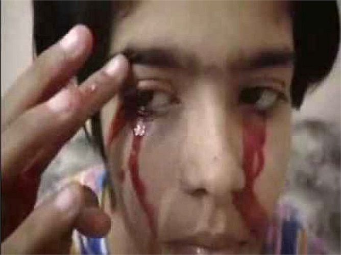 Cho đến nay, vẫn chưa có tài liệu khoa học chính thức nào thống kê số người mắc bệnh khóc ra máu, xác định chính xác nguyên nhân và biện pháp chữa trị căn bệnh này. Đây vẫn là một bài toán vô cùng hóc búa đối với giới y khoa trên toàn thế giới.