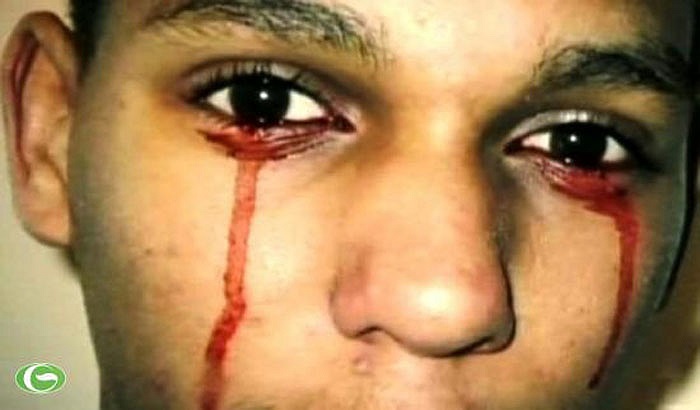 Và cũng có thể là do các bệnh như: Thiếu máu trầm trọng, máu trắng, máu khó đông, vàng da và rất nhiều các bệnh khác có liên quan tới máu. Hay đơn giản là do viêm nhiễm…