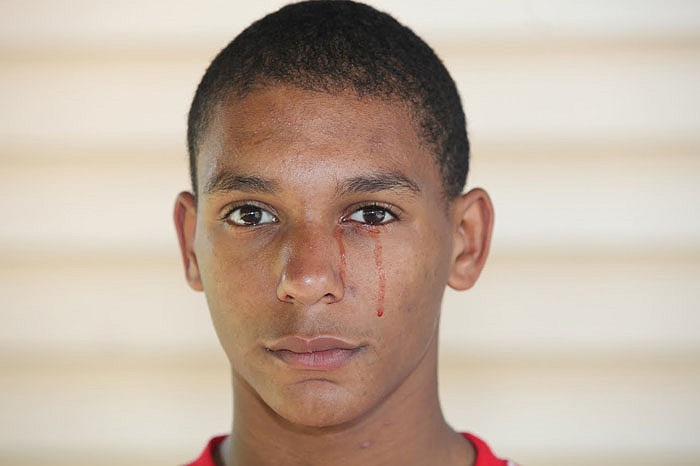 Tuy nhiên, nguyên nhân chính xác, cơ chế hoạt động của chứng chảy máu mắt, gọi là Haemolacria, vẫn là một bí ẩn làm đau đầu các nhà y khoa trên thế giới.