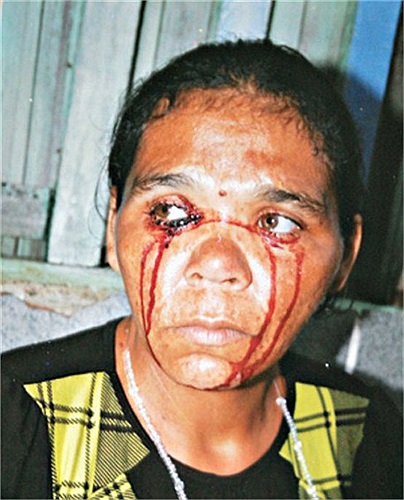 Người mắc chứng khóc ra máu không cảm thấy đau khi khóc. Sau mỗi lần như vậy, rửa mắt sạch thì đôi mắt trở lại bình thường mà không để lại bất kỳ vết xước nào.