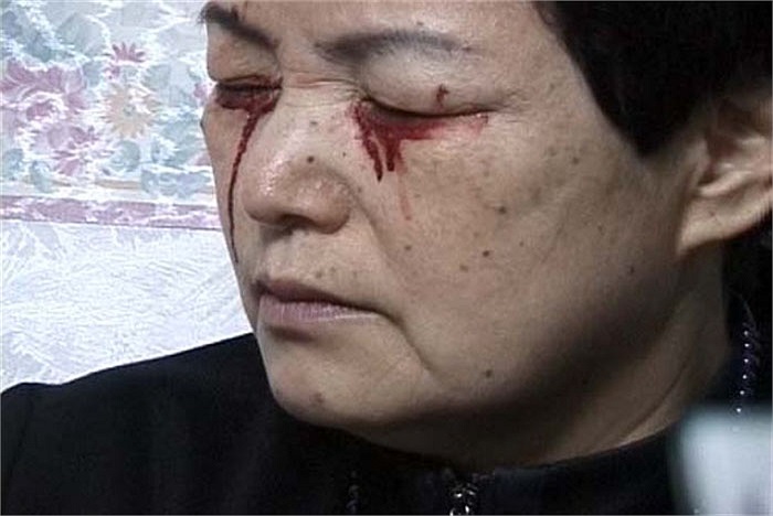 Và đặc biệt tất cả những trường hợp bệnh nhân mắc bệnh khóc ra máu đều chưa tìm thấy dấu hiệu cho thấy sự bất thường hay tổn thương nội tạng sau khi kiểm tra bằng máy móc tổng thể.