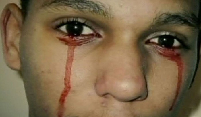 Với những người mắc chứng Haemolacria, máu có thể chảy ra vô cớ, từ 7 – 20 lần mỗi ngày tùy vào từng người.