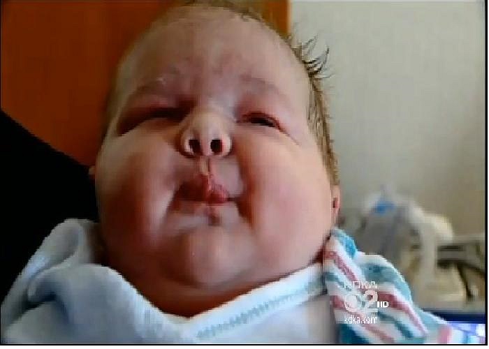 Bác sĩ Amy Tuner, người trực tiếp phẫu thuật cho cô Michelle Cessna (mẹ của bé), cho biết rằng, mới đầu họ chỉ nghĩ đứa trẻ chỉ nặng chừng 4,5-5 ký là cùng.