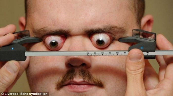 Anh John Doyle, 30 tuổi, ngụ tại Thành phố Liverpool của Anh, đã bị từ chối danh hiệu Người có đôi mắt lồi nhất thế giới với một lý do hết sức kỳ lạ.