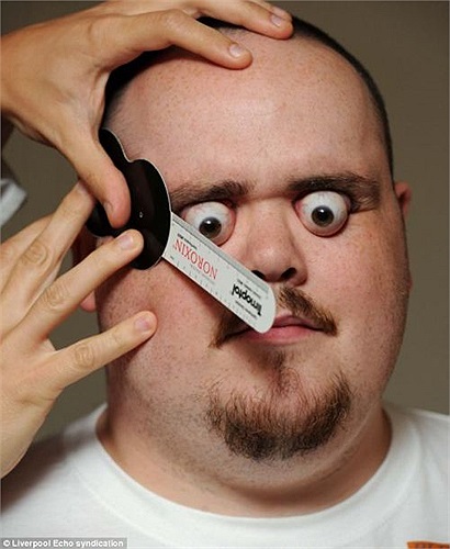 Được biết, loại thước mà các chuyên gia sử dụng để đo độ lồi của mắt anh Doyce chỉ dài tối đa là 12mm. Trong khi đó, người ta tin rằng mắt của anh lồi ra ngoài tới 14mm.