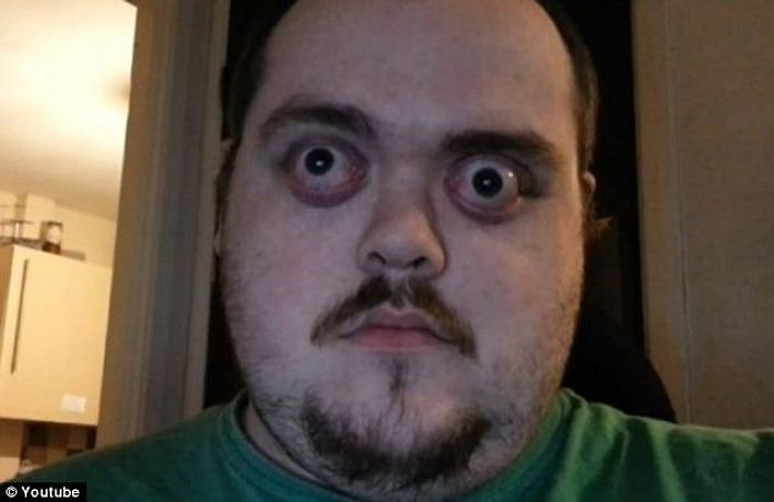 Với thất bại kể trên, anh Doyle quyết tâm sẽ phá vỡ kỷ lục thế giới trong vài tuần tới. Được biết, người đang nắm giữ danh hiệu mắt lồi nhất thế giới là chị Kim Goodman với 12mm.