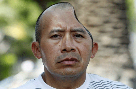 Lopez bị vỡ nửa hộp sọ