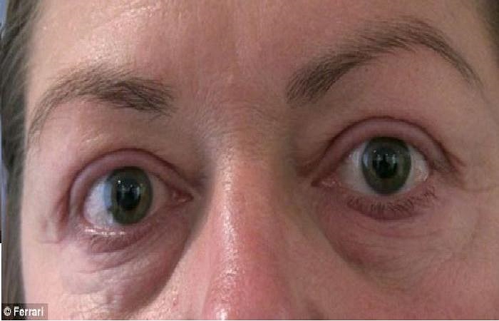 Tuy nhiên, gần đây người phụ nữ này đã quyết định chi đến 4000 bảng Anh (hơn 130 triệu đồng) cho ca phẫu thuật cấy ghép lông mi.