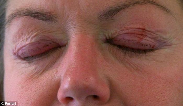 Trong ảnh là chị Medcalf lúc chưa phẫu thuật. Chị cho biết rằng đôi mắt của chị trông như mắt ếch vì căn bệnh rụng lông mi của mình.