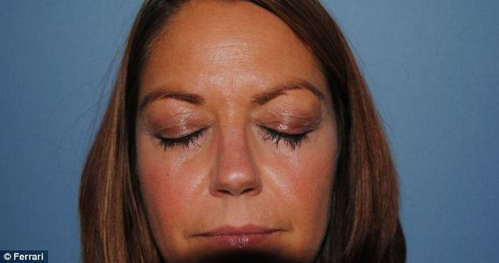 Bác sĩ Shahmalak tại một bệnh viện ở Manchester, đã phẫu thuật cấy ghép đến 70 sợi lông mi mới cho chị trong ca phẫu thuật kéo dài 3 tiếng. Hình ảnh chụp bệnh nhân sau khi cấy ghép thành công lông mi.