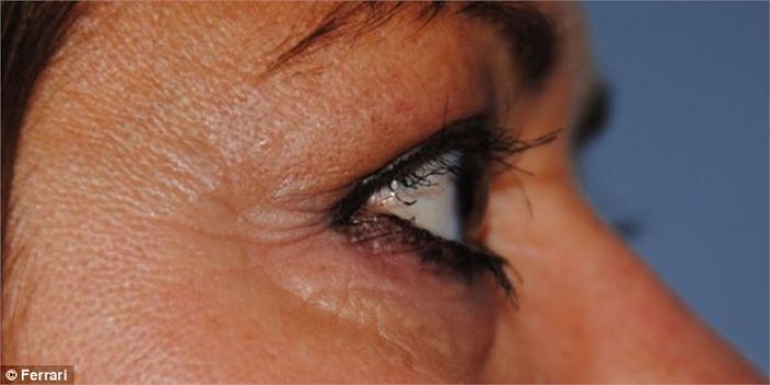 Giờ đây, người phụ nữ này đã có được một bộ lông mi mới, cuộc sống của chị đã đỡ bớt phiền phức và tự tin hơn so với lúc đeo lông mi giả.