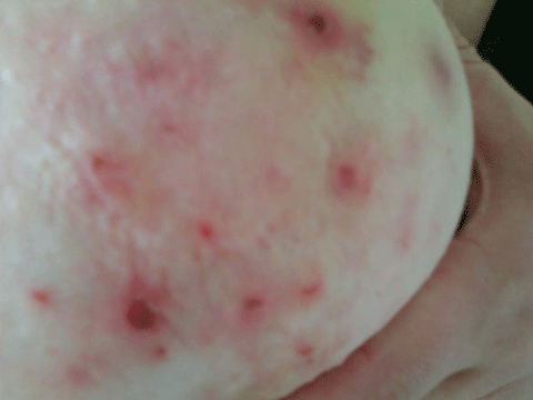 Khắp cơ thể nhằng nhịt những vết sẹo vình viễn