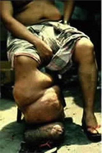 Bệnh chân voi: Những người mắc bệnh này có các bộ phận trên cơ thể như chân, tay, ngực, bộ phận sinh dục ngoài phồng to với kích thước khổng lồ. Khi bị muỗi cái có mầm bệnh đốt, người bệnh sẽ bị các ký sinh trùng gây bệnh làm tổ.