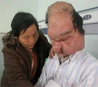 Hội chứng mặt Sư tử (Leontiasis Ossea), cũng được gọi là Leontiasis hoặc Mặt sư tử, là một triệu chứng y khoa hiếm có, đặc trưng bởi phát triển quá mức của xương mặt và sọ. Chúng xảy ra từ từ và gây mất hoàn toàn thị giác.