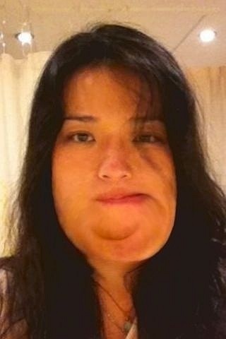 Một vài trường hợp của căn bệnh hiếm gặp này do sự phát triển quá mức của xương ảnh hưởng đến tất cả các xương sọ cũng như tất cả các bộ phận khác trên khuôn mặt, các giác quan bị mất từ từ và người bệnh sẽ chết do các áp lực chèn lên não. 