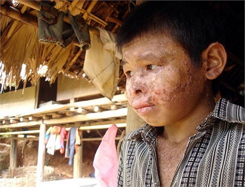 Bệnh khô da đậm sắc tố: Bệnh này có tên khoa học là Xeroderma Pimentosum, căn bệnh này rất hiếm gặp và chưa rõ căn nguyên.