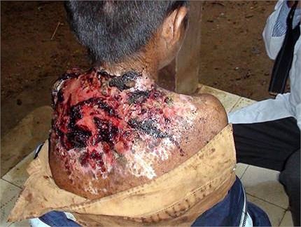 Hiện nay vẫn chưa thể kết luận được đây là hiện tượng ngẫu nhiên hay do ảnh hưởng của môi trường. Hiện ngành y cũng chưa có nghiên cứu nào về vấn đề này và chưa có phác đồ điều trị dứt điểm.