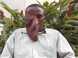 Bệnh Neurofibromatosis hoặc bệnh von Recklinghausen: là bệnh do rối loạn có tính di truyền, trong đó các mô thần kinh phát triển thành các khối u (neurofibromas) có thể là lành tính hoặc có thể gây ra những tổn hại nghiêm trọng.