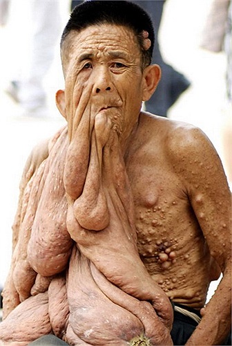 Rối loạn này ảnh hưởng đến tất cả các tế bào mào thần kinh (các tế bào Schwann, tế bào biểu bì tạo hắc tố và các nguyên bào sợi endoneurial). Các phân tử của loại tế bào này sinh sôi nảy nở quá mức trong cơ thể, hình thành các khối u, tế bào biểu bì.