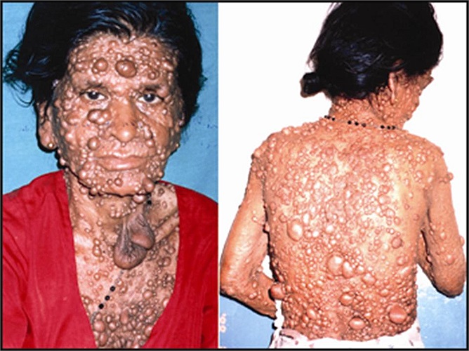 Chúng có thể gây ra các khối u dưới da, các vết sẩm màu trên da, các vấn đề về xương, áp lực trên các rễ thần kinh cột sống, và các vấn đề thần kinh khác.