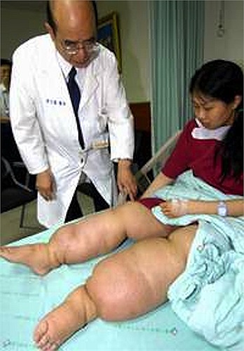 Bệnh này hiện đang cư trú ở 120 triệu người trên toàn thế giới và 40 triệu người trong số này đang ở giai đoạn khá nguy hiểm.