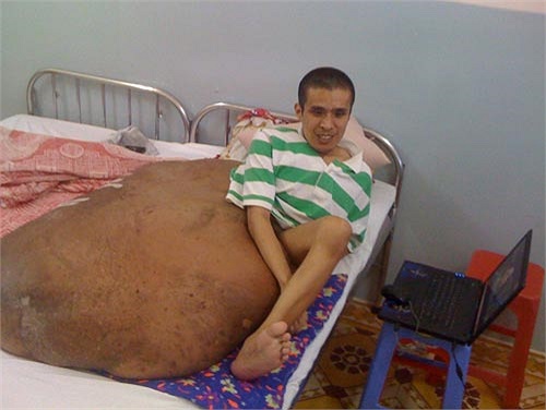 Việc điều trị bằng thuốc diệt giun có hiệu quả cao nhất nếu được áp dụng từ sớm. Tuy nhiên, do bệnh thường được phát hiện muộn nên thuốc không phát huy nhiều tác dụng. 