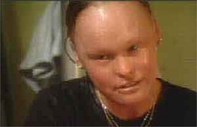 Bệnh vảy cá: Người mắc phải căn bệnh này đều có một làn da dễ tróc, mắt, mũi, tai, miệng đều có xu hướng lộn ra bên ngoài. Căn bệnh này do rối loạn nội tiết da mãn tính khiến da trở nên khô ráp và sần sùi như vảy cá.