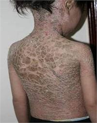 Đây là một loại bệnh di truyền theo đường máu và hoàn toàn không hề lây nhiễm qua tiếp xúc. Những người mắc bệnh vảy cá rất dễ bị vi khuẩn và các tác nhân ô nhiễm khác xâm nhập khiến nguy hiểm đến tính mạng.