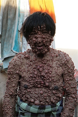 Chandra Wisnu, một ông bố 4 con sống ở Indonesia bị mắc chứng bệnh Neurifibromatosis, khiến cơ thể của ông nổi đầy khối u. 