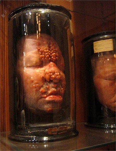 Khuôn mặt của một người đàn ông bị di chứng của bệnh giang mai, một căn bệnh mà trước đây y học đã phải bó tay. 