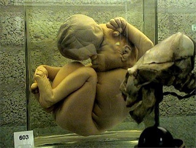 Khối u trên trán dẫn tới cái chết của em bé này. 