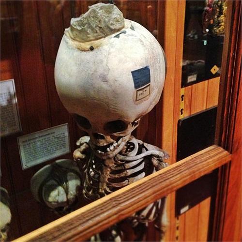 Khung xương của em bé mắc chứng đầu to.