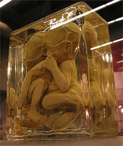 Hình ảnh cặp song sinh dính liền gây nhiều khiếp sợ cho người xem. 