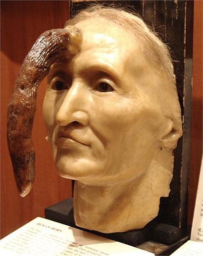 Khuôn mặt bị dị tật kì lạ với một chiếc sừng mọc ra giữa trán này là của Madame Dimanche, một phụ nữ người Pháp sống hồi đầu thế kỷ 19. 