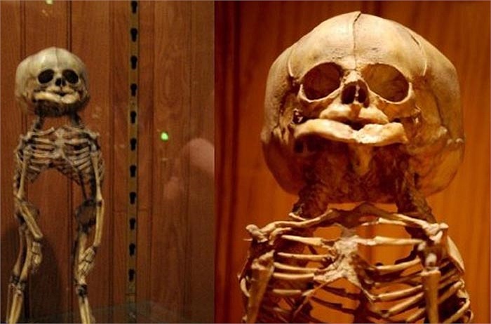 Khung xương của cặp sinh đôi dính liền phần đầu và ngực, nhưng lại chỉ chung một đôi mắt và mồm. 