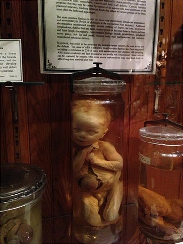 Một bộ sưu tập những bào thai chết lưu.