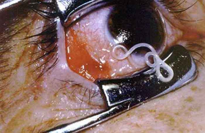 Ấu trùng đi vào cơ thể thông qua các vết cắn của con ruồi và chui vào da vật chủ tồn tại khoảng 15 năm bên trong vật chủ sau đó chúng sẽ di chuyển sâu vào bên trong các mô của cơ thể. Các triệu chứng dễ nhận thấy là bị ngứa ngáy, đau khớp và thậm chí