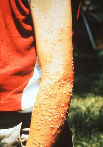  Kiến lửa (Solenopsis). Kiến lửa thường đốt và truyền chất độc vào người nạn nhân. Bình thường thì lượng chất độc này không đủ gây ra tác hại nào cho con người. Tuy nhiên, với số lượng nhiều, và với những người bị dị ứng với chất độc của kiến lửa, lo