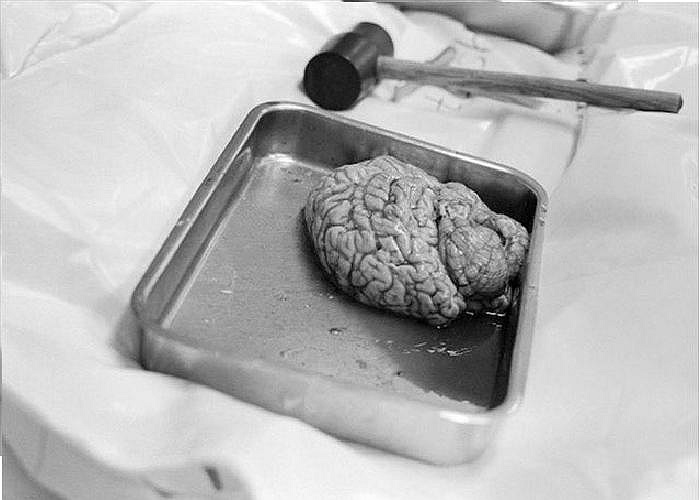 Một bộ phận trên cơ thể người được lấy ra đem đi khám nghiệm.