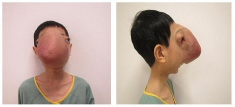 Phẫu thuật thành công: Cậu bé không có khuôn mặt người