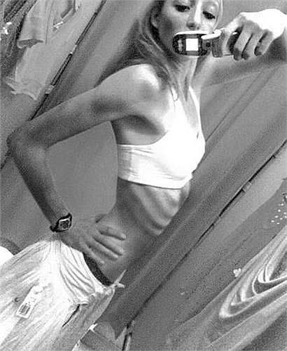  Xương sườn lộ rõ trên cơ thể một cô gái mắc chứng bệnh chán ăn.