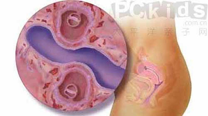 Cặp song sinh 4 tuần tuổi trong dạ con mẹ.