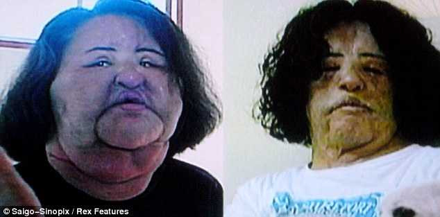 Mặt Hang sau khi phẫu thuật bằng dầu ăn