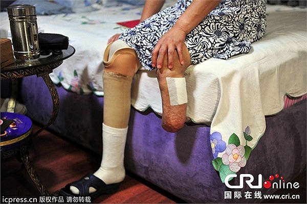 Cô cần 200.000 nhân dân tệ (gần 700 triệu đồng) để trang trải cho ca phẫu thuật đĩa đệm cột sống của mình.