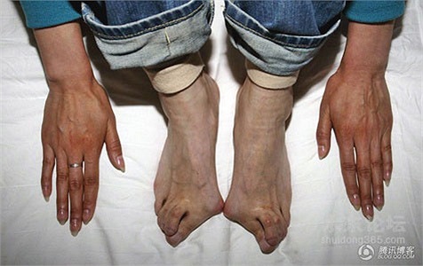 Đôi chân biến dạng của Quách Bình